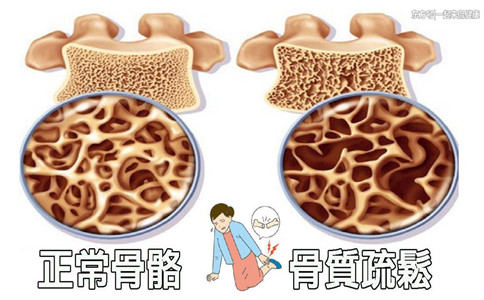 國產(chǎn)骨密度檢查儀